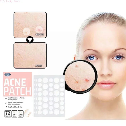 SpotGone™ Anti-Acne — Protection discrète, puissante et efficace contre l'acné !
