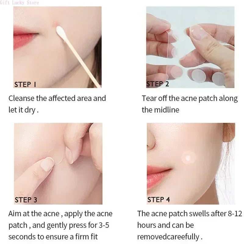 SpotGone™ Anti-Acne — Protection discrète, puissante et efficace contre l'acné !
