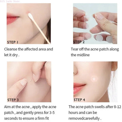 SpotGone™ Anti-Acne — Protection discrète, puissante et efficace contre l'acné !