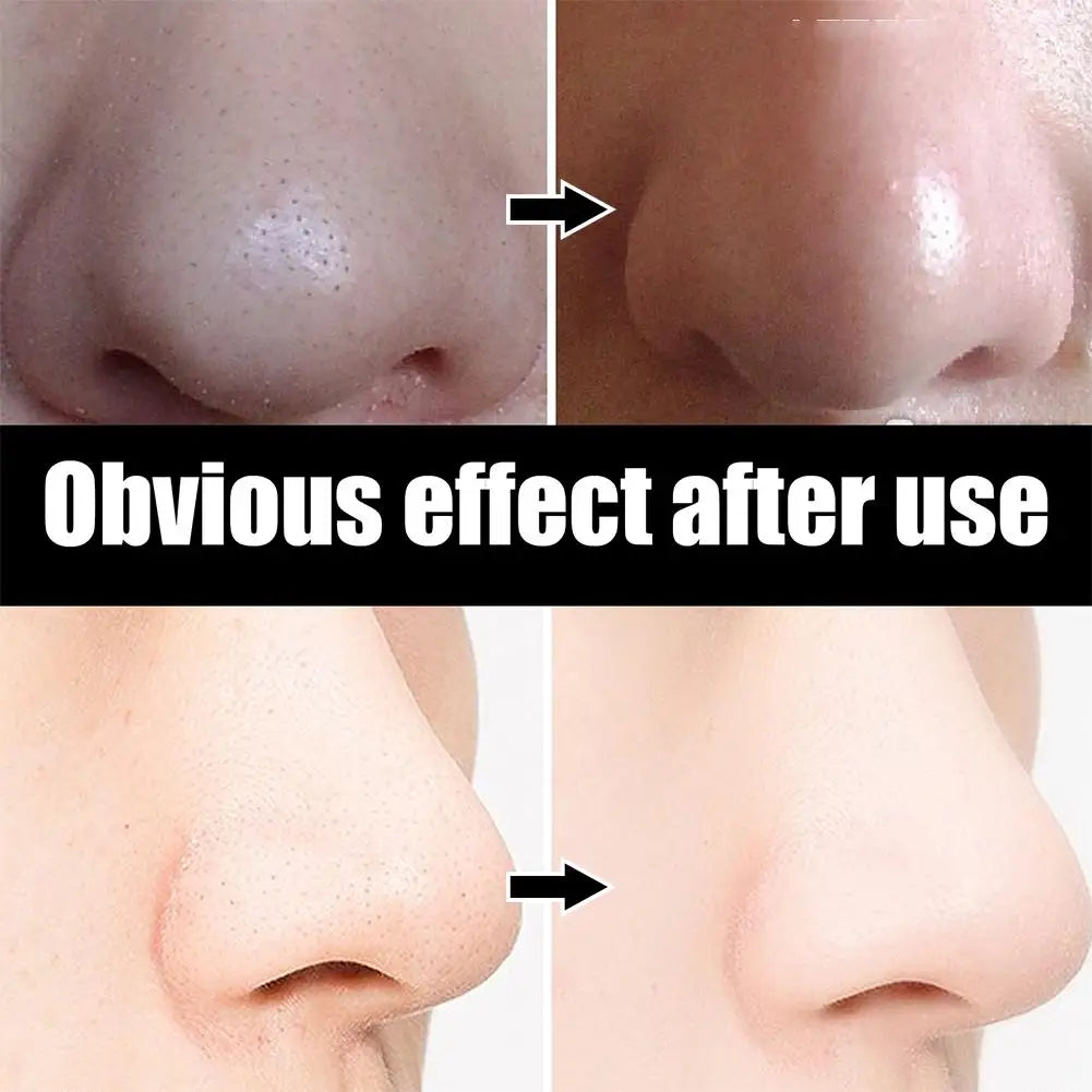 Éliminateur de points noirs SkinGuard™ — Nettoyage en profondeur des pores pour une peau claire et lisse ! 